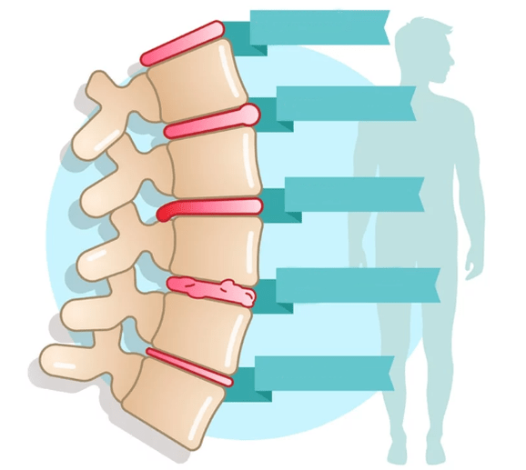 Stopień choroby osteochondrozy klatki piersiowej
