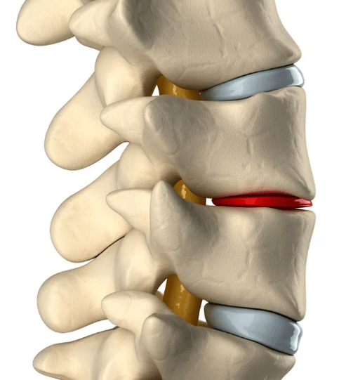 osteochondroza kręgosłupa klatki piersiowej