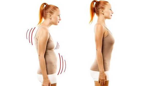 proste plecy i zła postawa z osteochondrozą szyjną