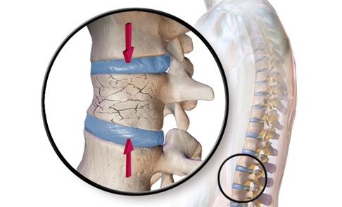 Osteochondroza szyjna II stopnia charakteryzuje się zmianami zwyrodnieniowymi w samych kręgach