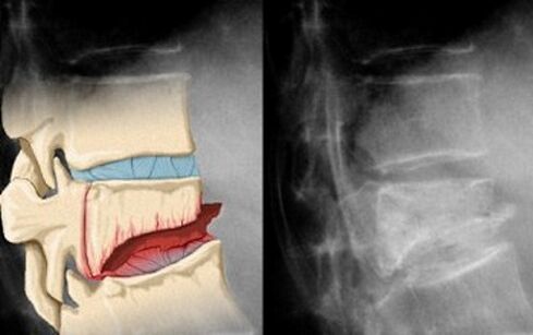 Pęknięcia krążków międzykręgowych w pierwszym stadium osteochondrozy szyjnej